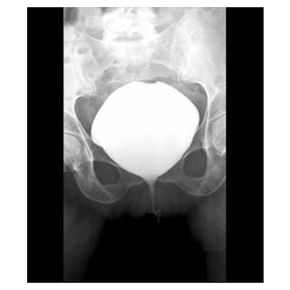 Wall Art  Posters  Full bladder, X ray cystography