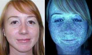 SAM T3 (220 Volt) Face Skin Scanner UV Analysis Machine + Custom Carry